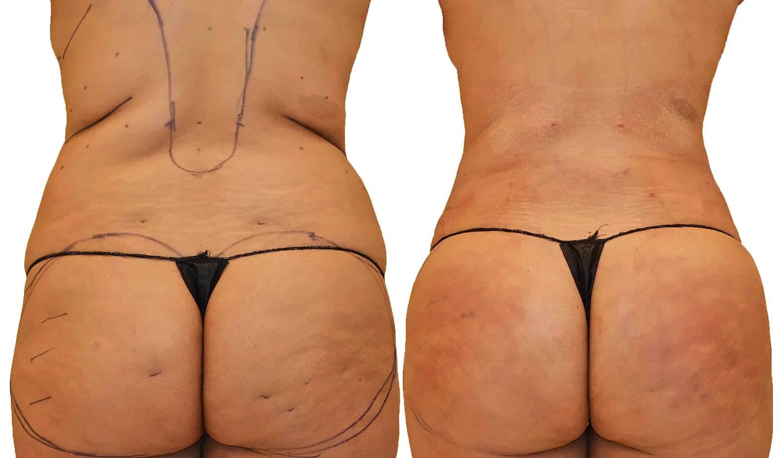Fat Transfer, BBL before and after, actual patient of Dr. Long