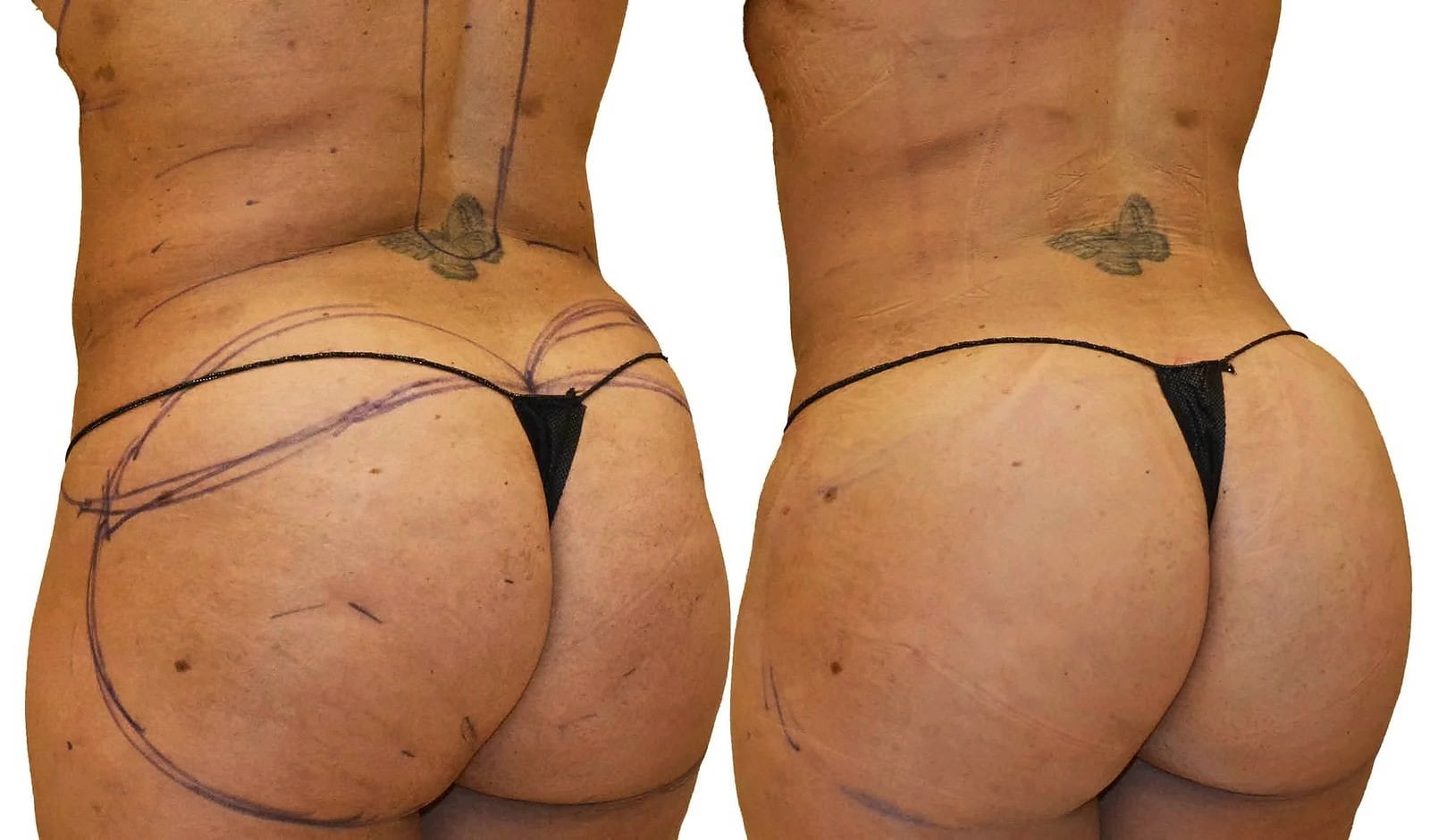Fat Transfer, BBL before and after, actual patient of Dr. Long