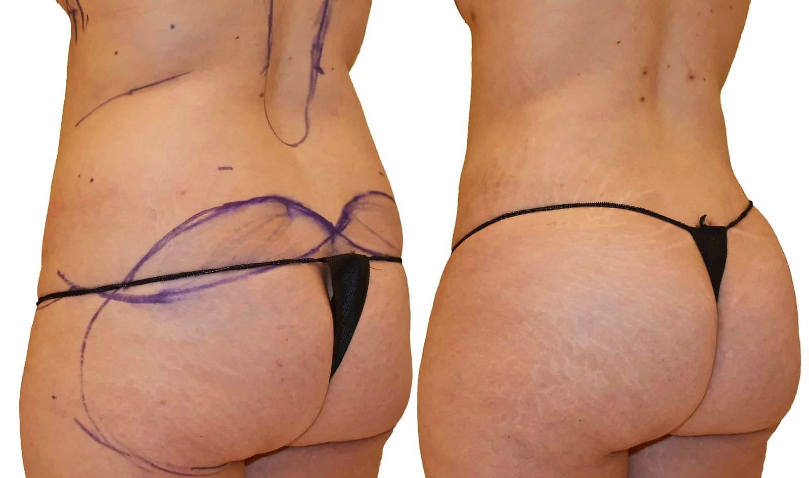 Fat Transfer, BBL before and after, actual patient of Dr. Long