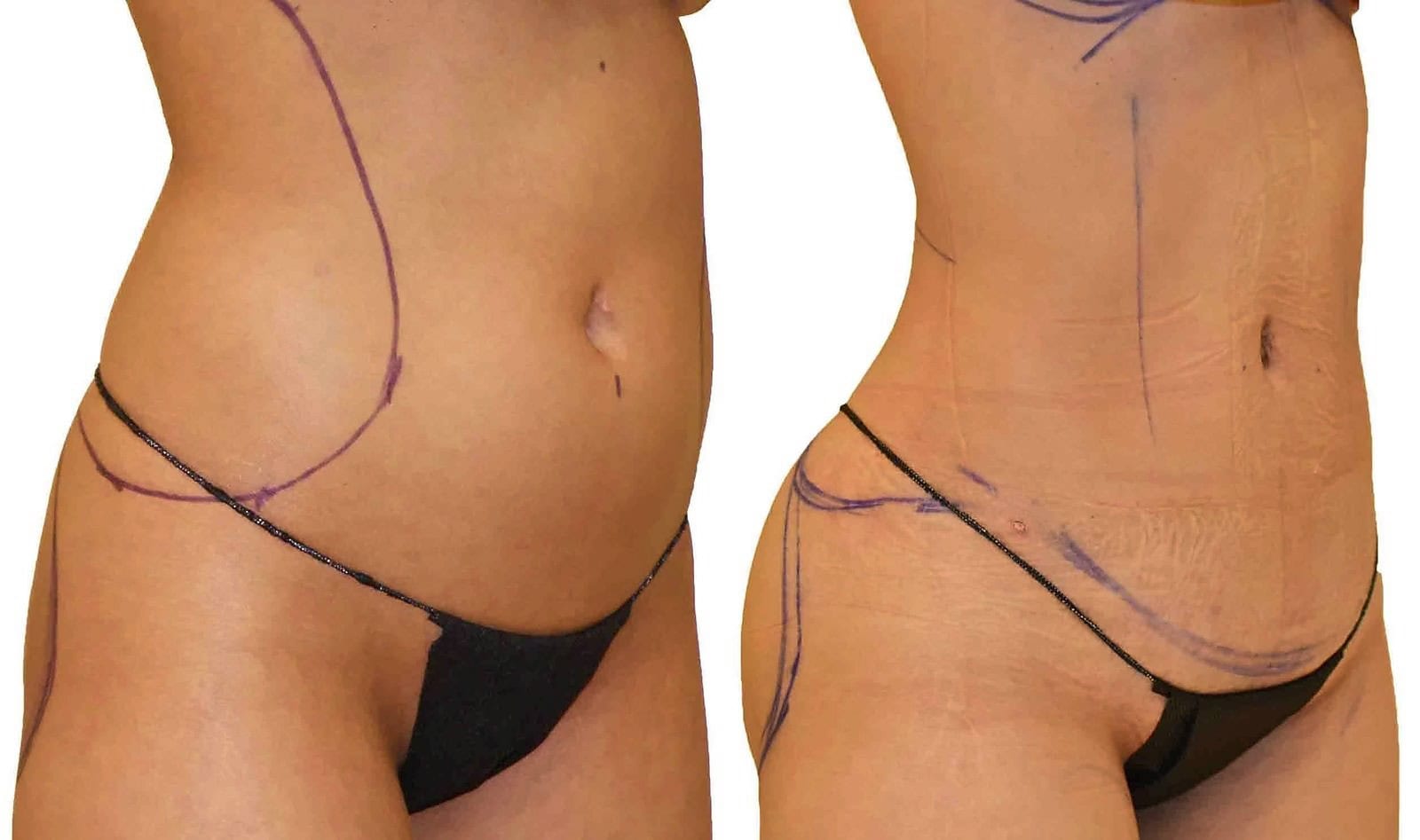 Lipo 360 before and after, actual patient of Dr. Long