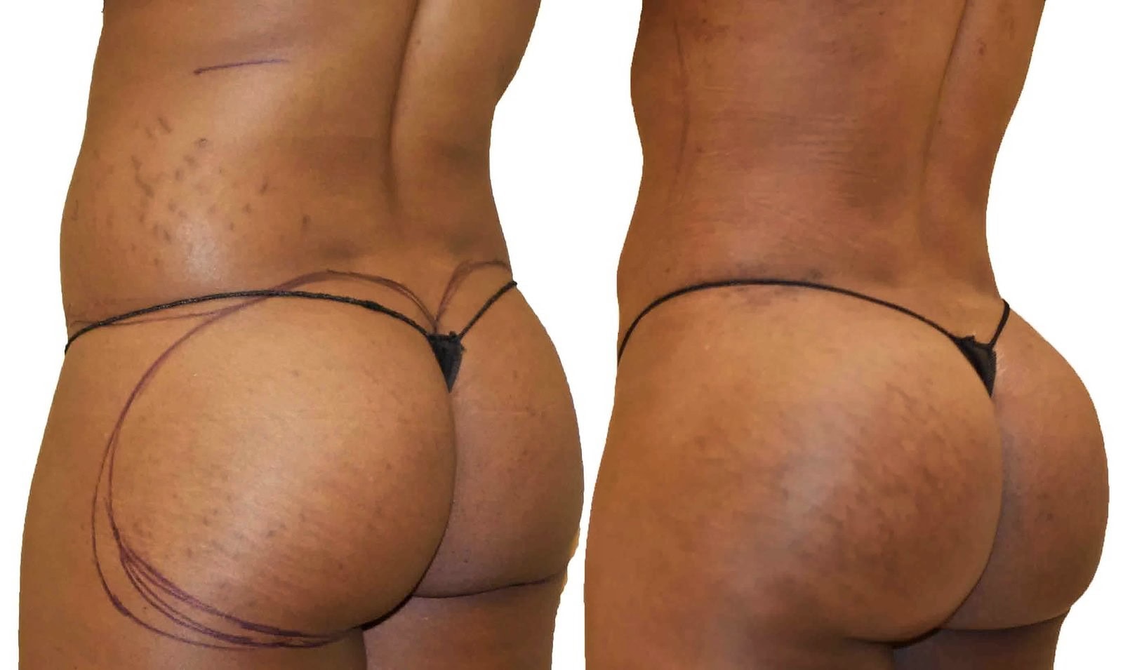 Fat Transfer, BBL before and after, actual patient of Dr. Long