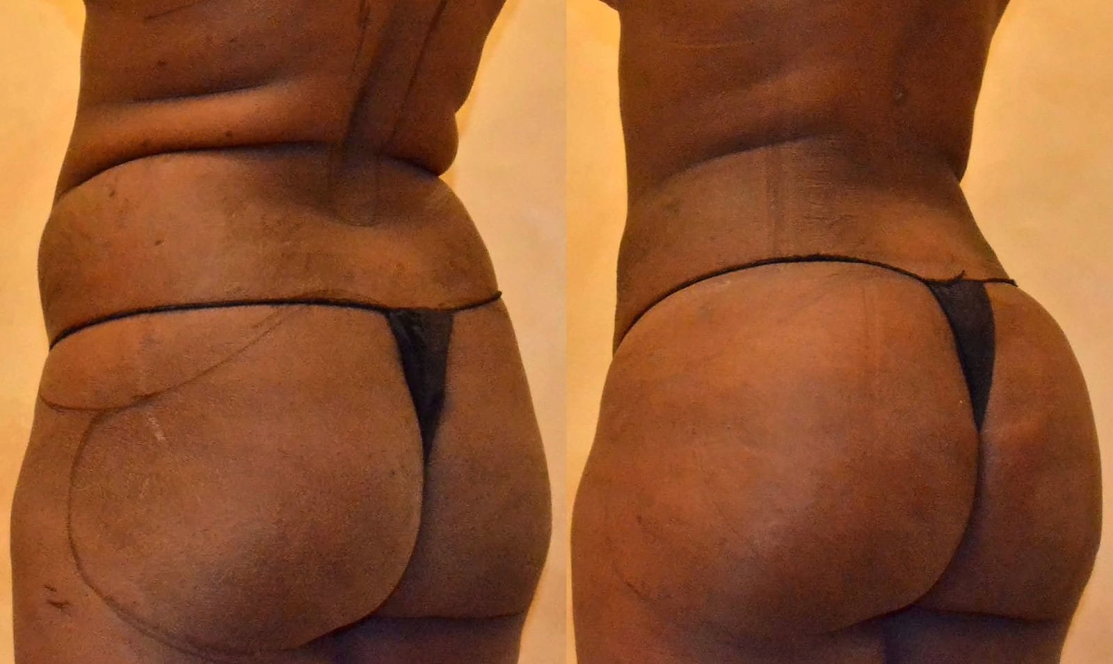 Fat Transfer, BBL before and after, actual patient of Dr. Long