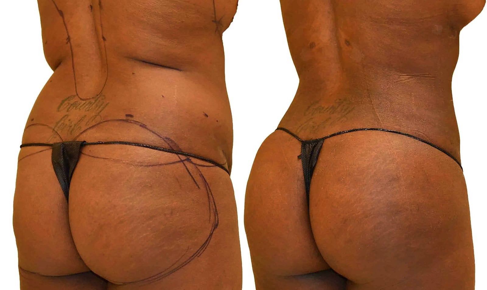 Fat Transfer, BBL before and after, actual patient of Dr. Long