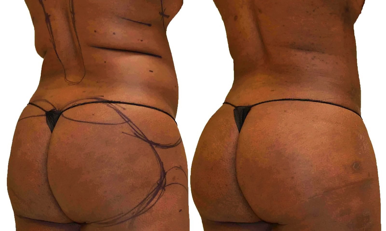 Fat Transfer, BBL before and after, actual patient of Dr. Long