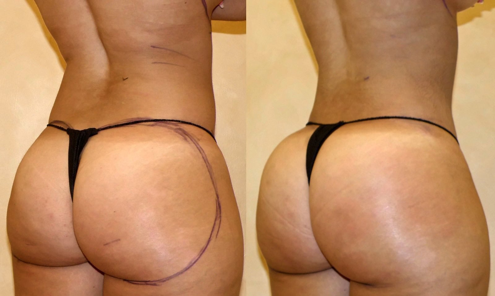 Fat Transfer, BBL before and after, actual patient of Dr. Long