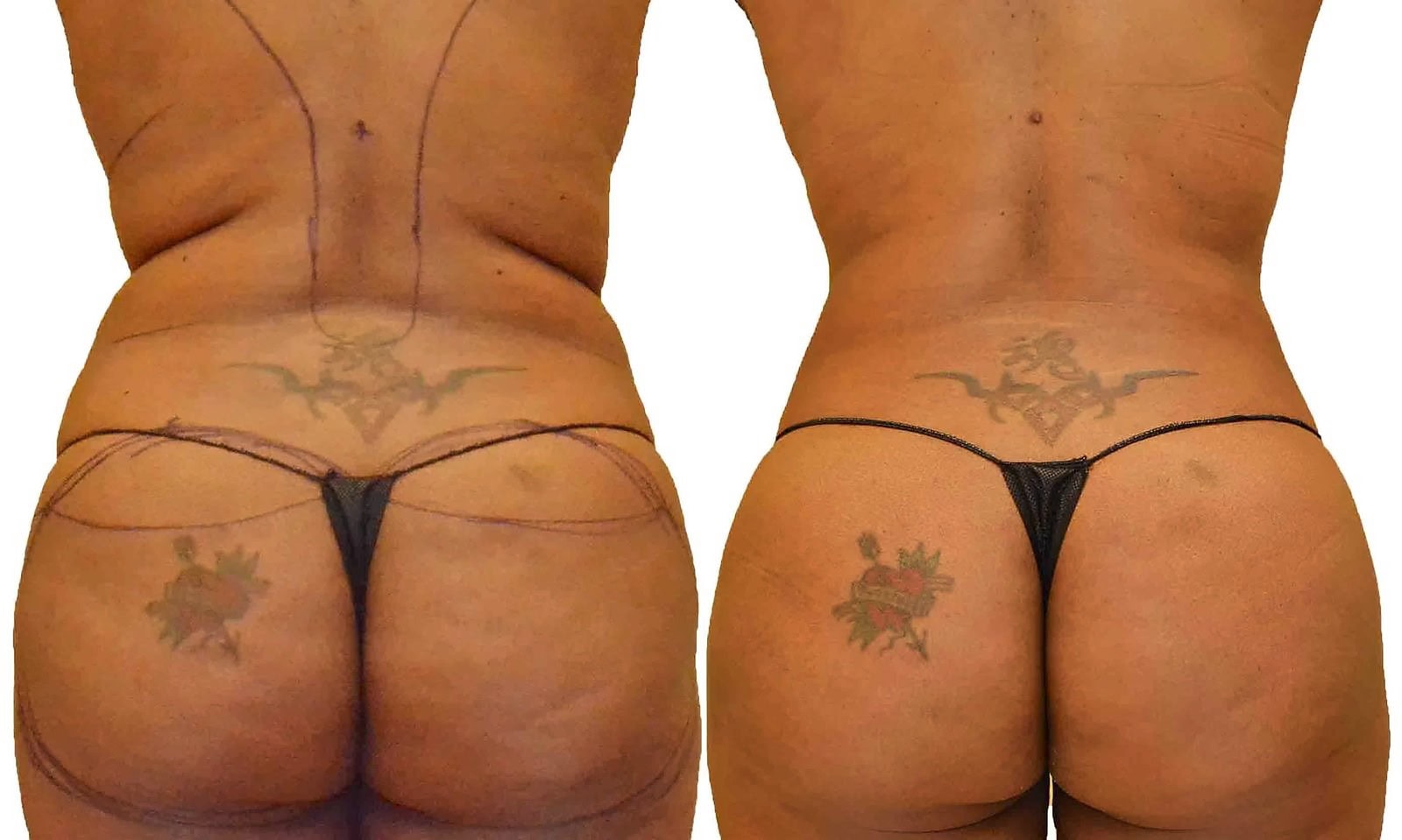 Fat Transfer, BBL before and after, actual patient of Dr. Long
