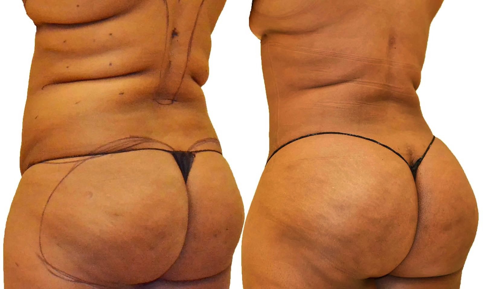 Fat Transfer, BBL before and after, actual patient of Dr. Long