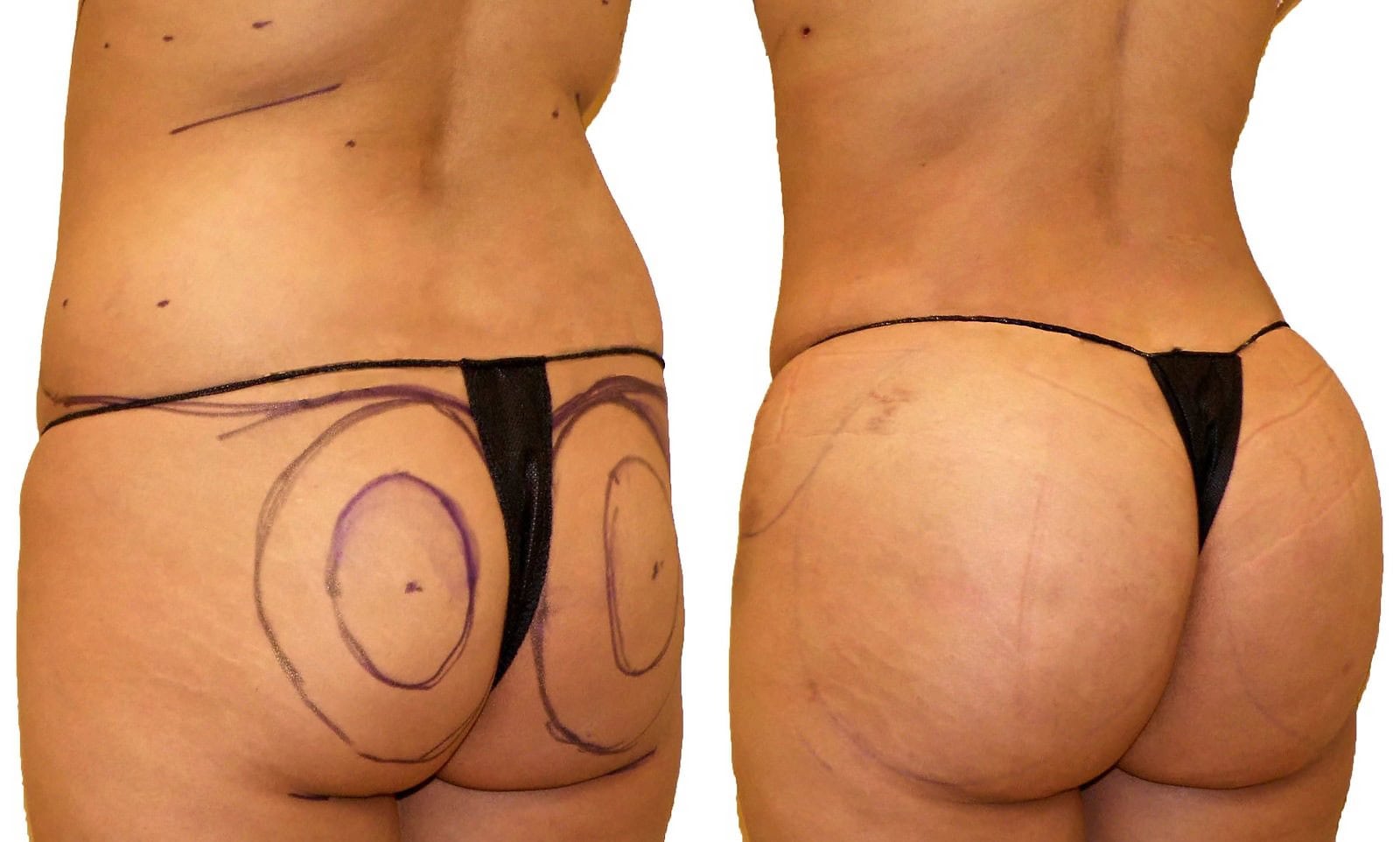 Fat Transfer, BBL before and after, actual patient of Dr. Long