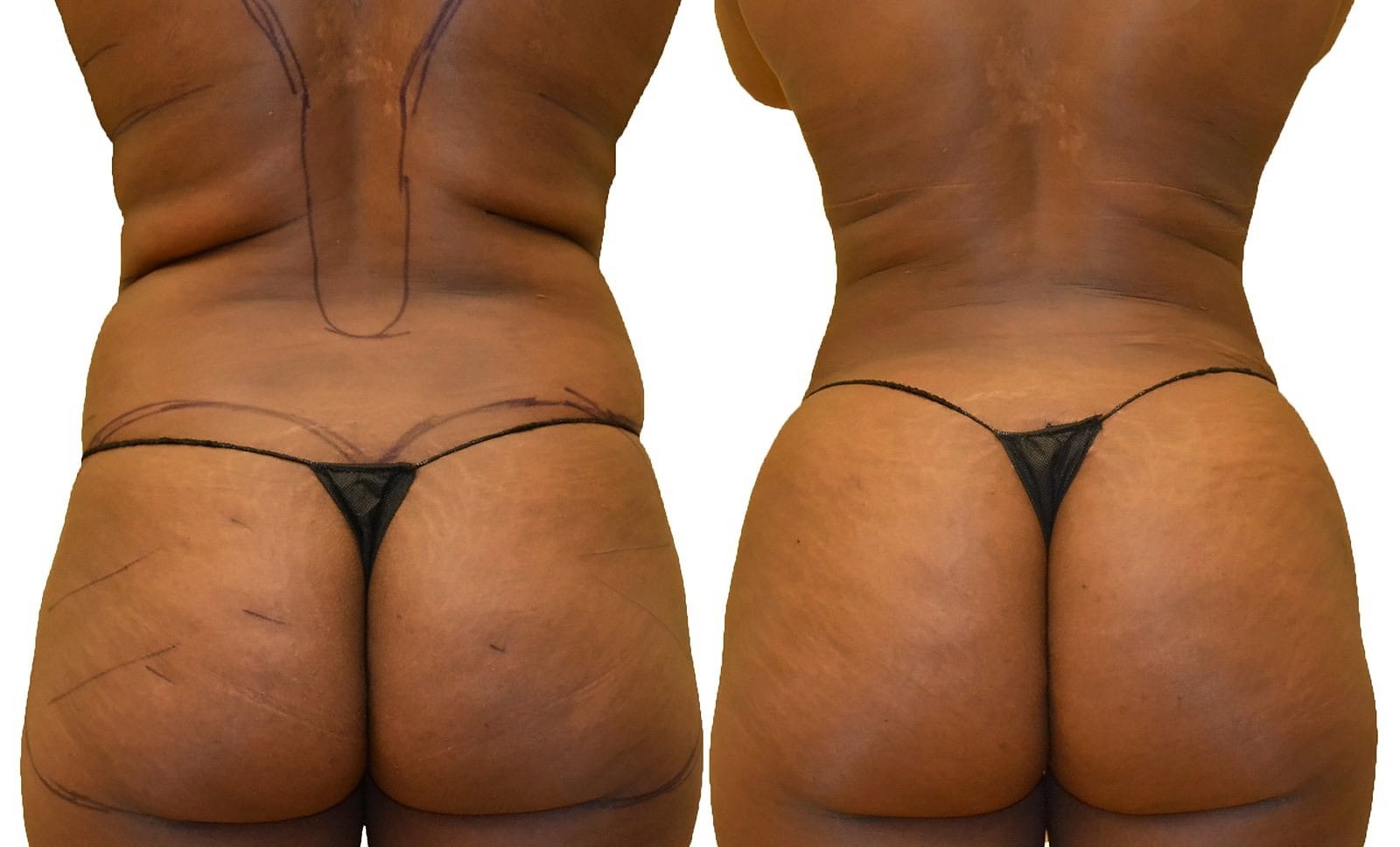 Fat Transfer, BBL before and after, actual patient of Dr. Long