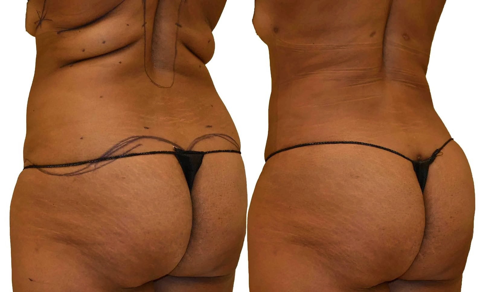 Fat Transfer, BBL before and after, actual patient of Dr. Long