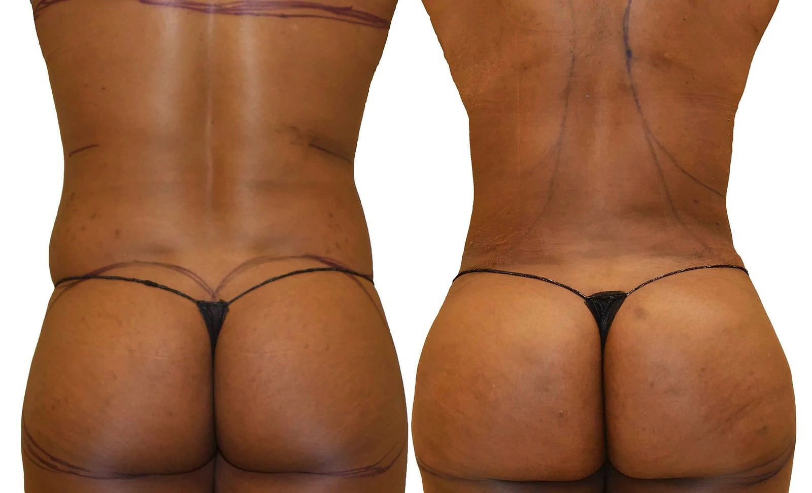 Fat Transfer, BBL before and after, actual patient of Dr. Long