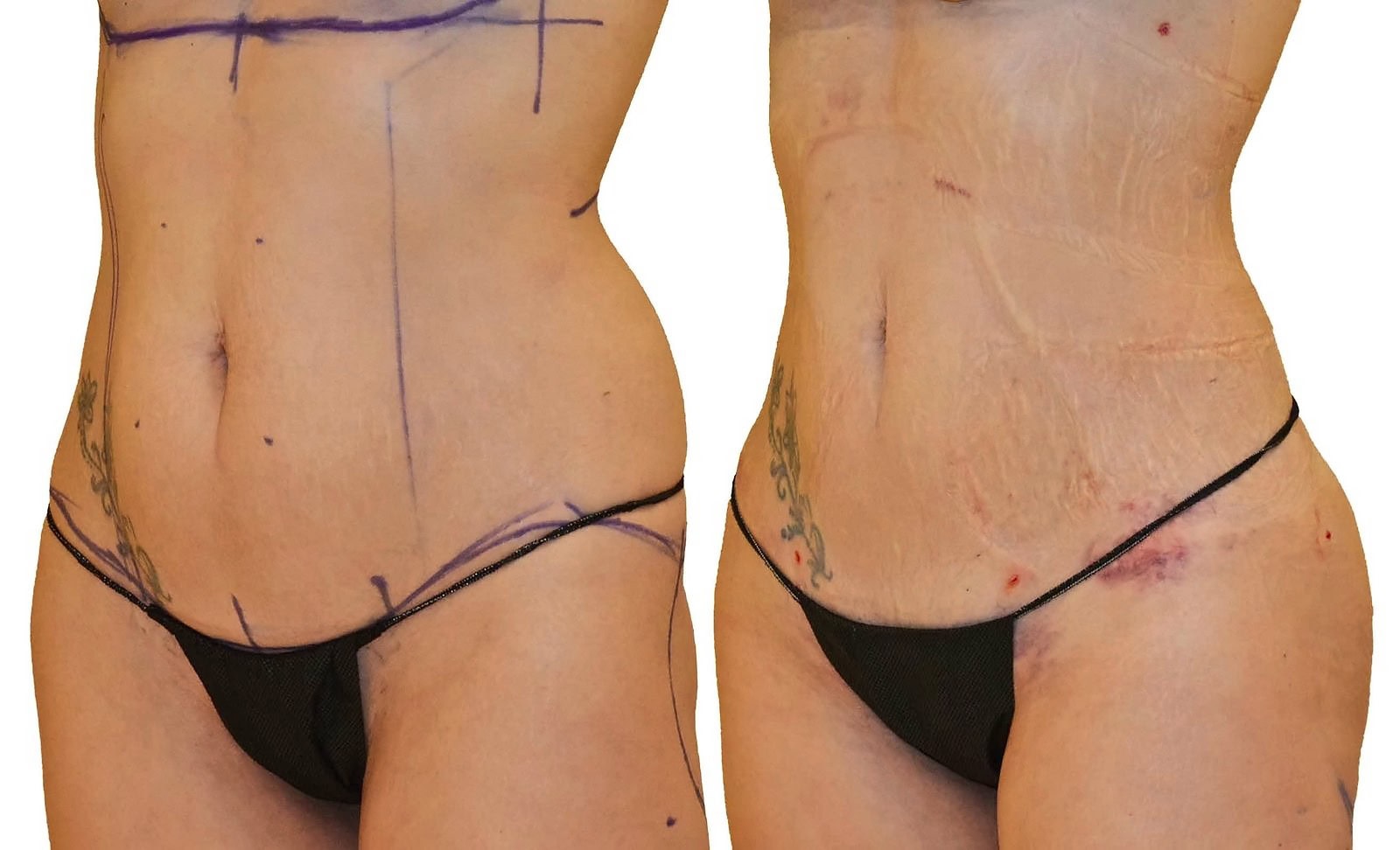 Lipo 360 before and after, actual patient of Dr. Long
