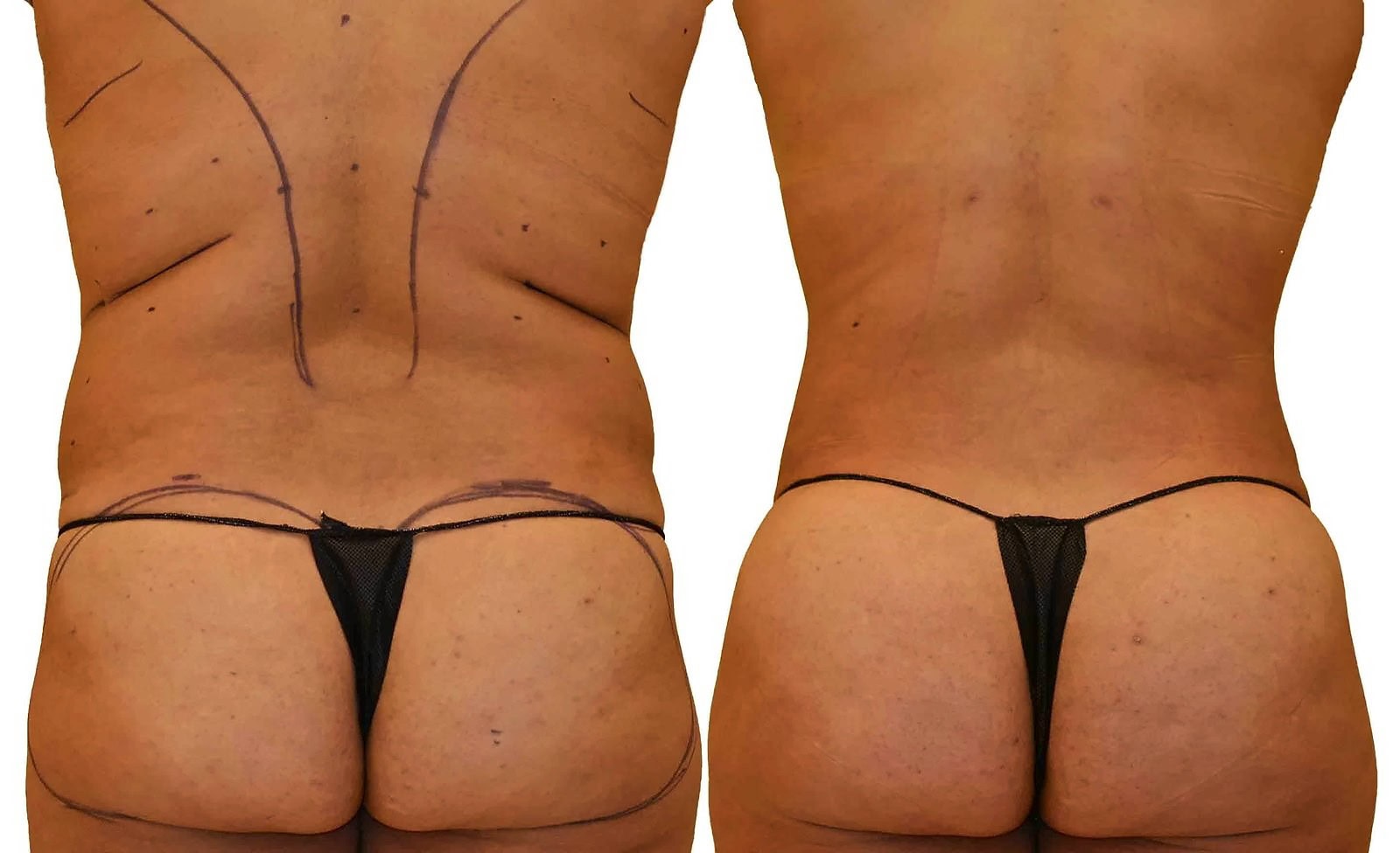 Fat Transfer, BBL before and after, actual patient of Dr. Long