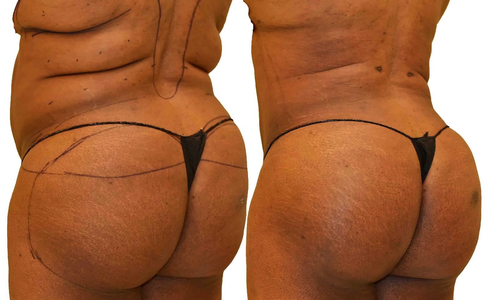 Fat Transfer, BBL before and after, actual patient of Dr. Long