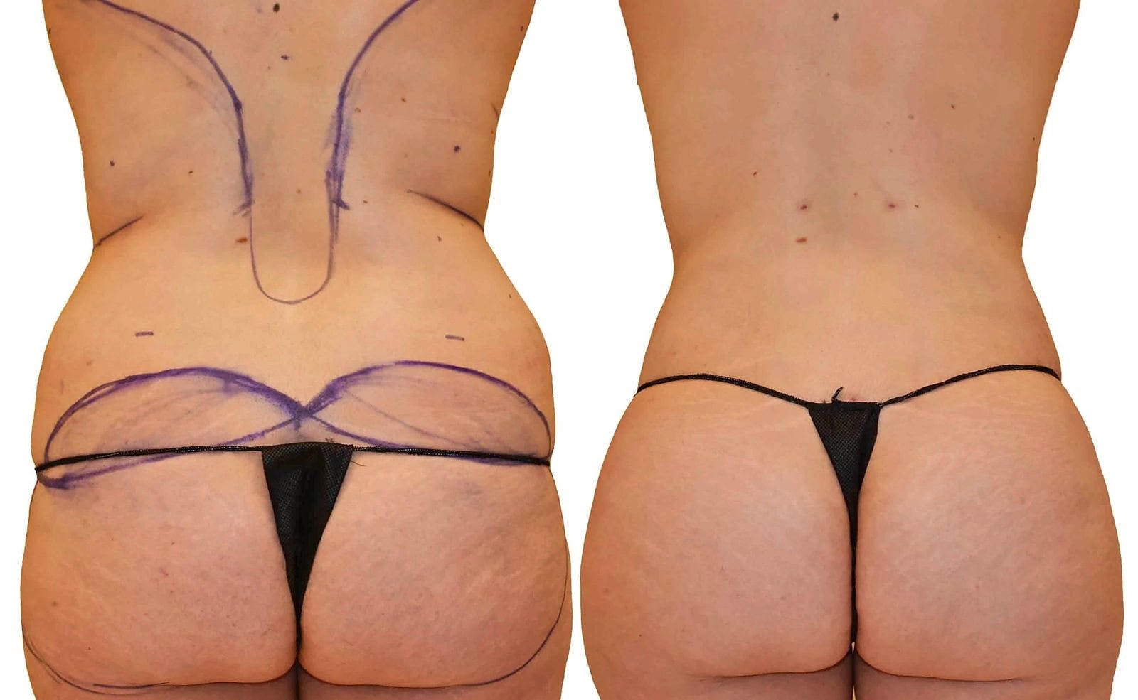 Fat Transfer, BBL before and after, actual patient of Dr. Long