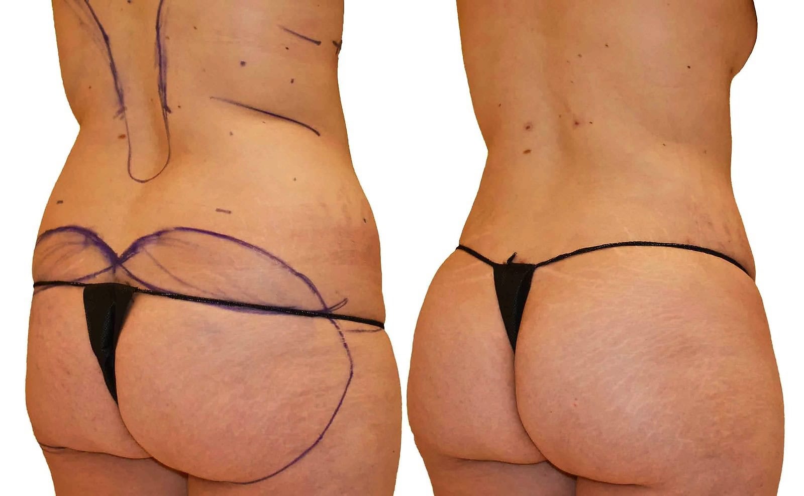 Fat Transfer, BBL before and after, actual patient of Dr. Long