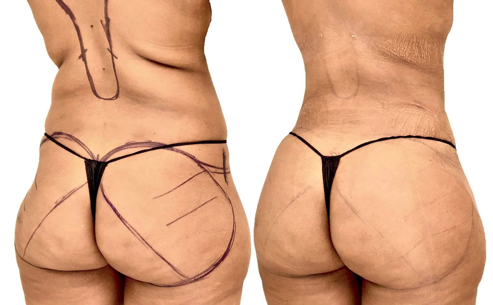 Fat Transfer, BBL before and after, actual patient of Dr. Long