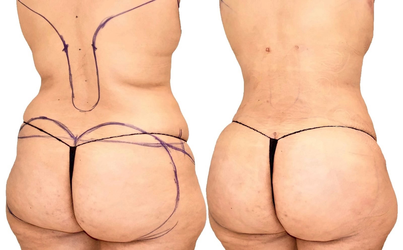Fat Transfer, BBL before and after, actual patient of Dr. Long
