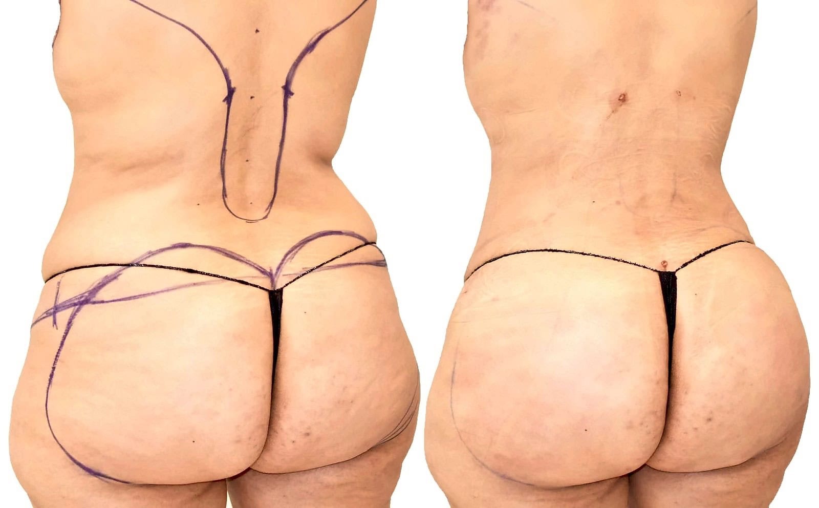 Fat Transfer, BBL before and after, actual patient of Dr. Long