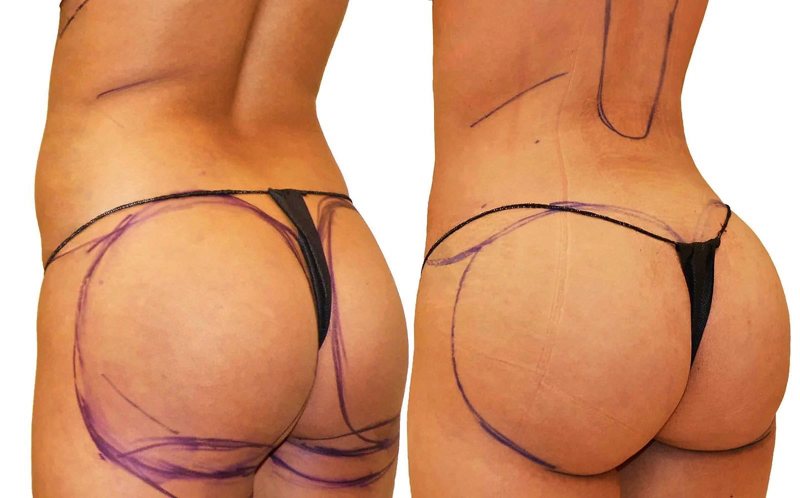 Fat Transfer, BBL before and after, actual patient of Dr. Long