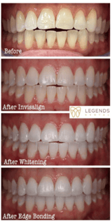 before and after teeth photo of invisalign and cosmetic treatment