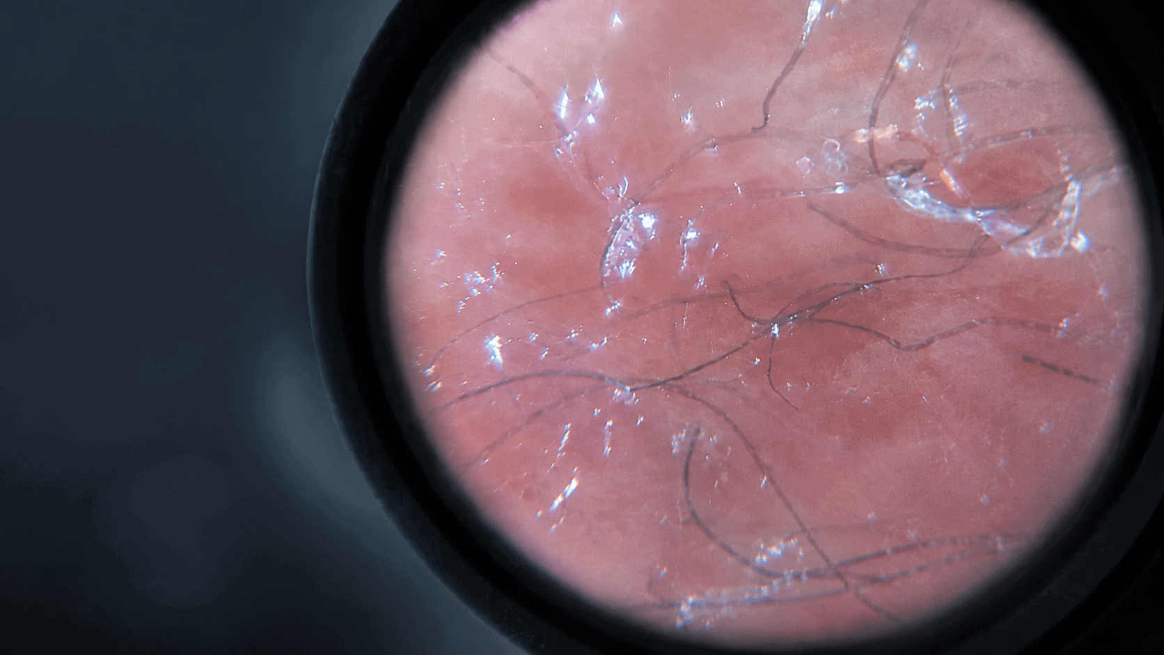 Tick-borne relapsing fever and Morgellons research image showing skin under magnification with fine irregular fibers.