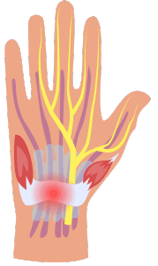 Carpal Tunnel Syndrome