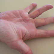 Dupuytren's contracture hand deformity