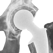 X-ray of total hip replacement prosthesis after surgery