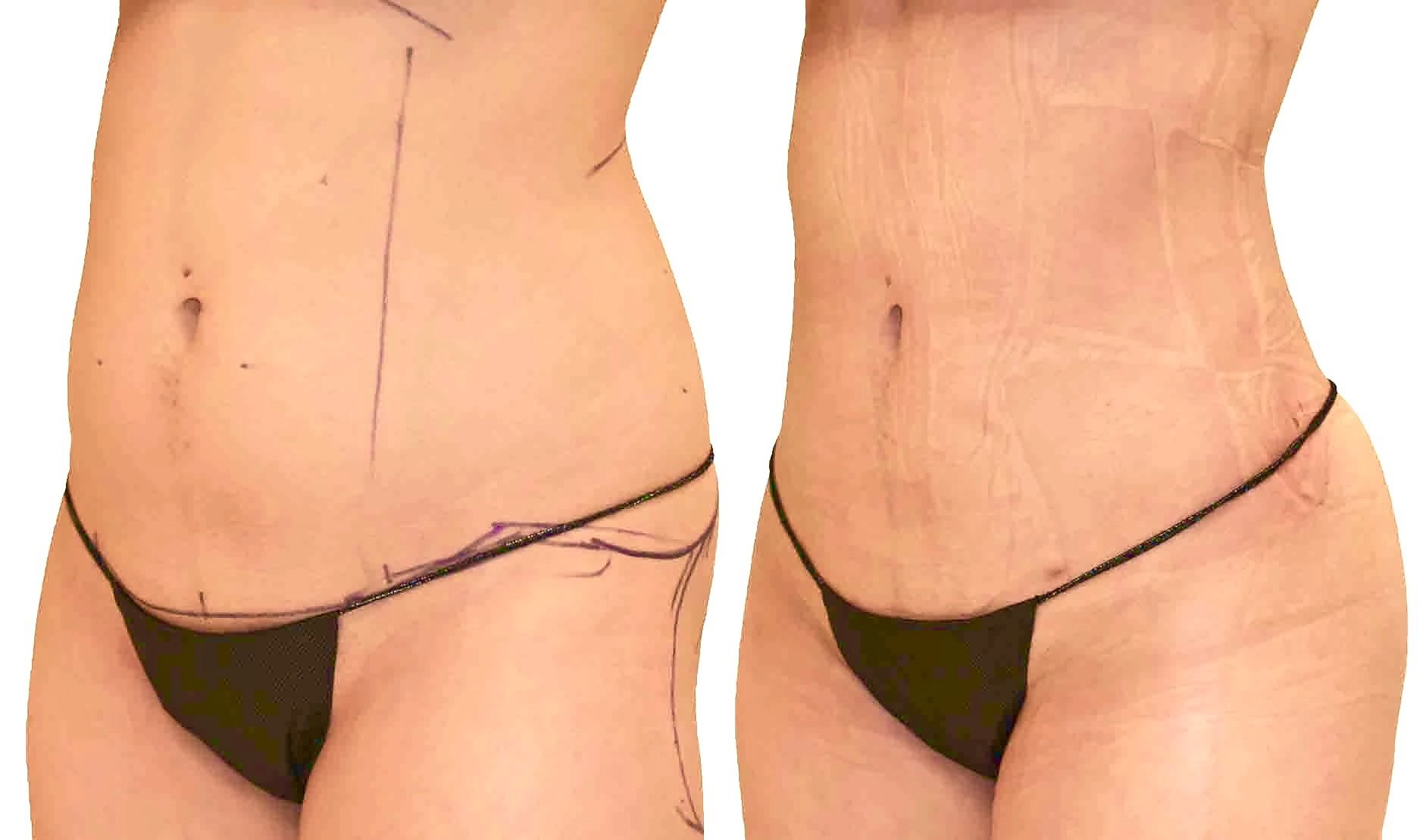 Lipo 360 before and after, actual patient of Dr. Long