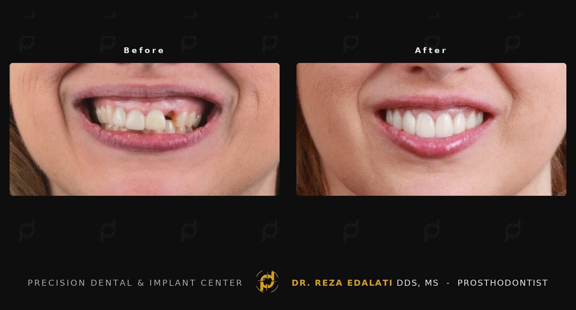 Dental implant before and after at Precision Dental in New Orleans