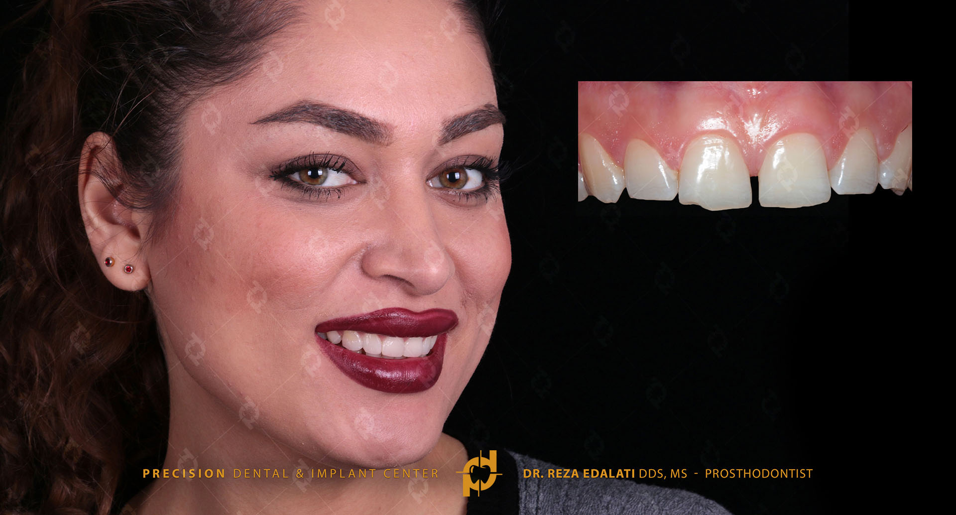 Veneer composite before and after at Precision Dental