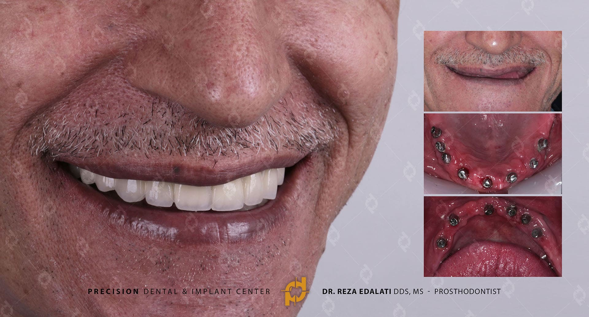 Full mouth dental implant transformation by Dr. Reza Edalati