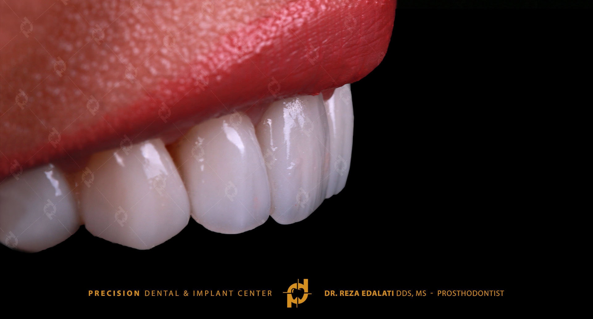 Before and after ceramic veneers at Precision Dental