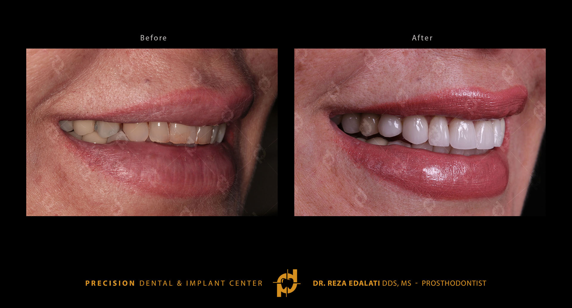 Before and after smile makeover at Precision Dental