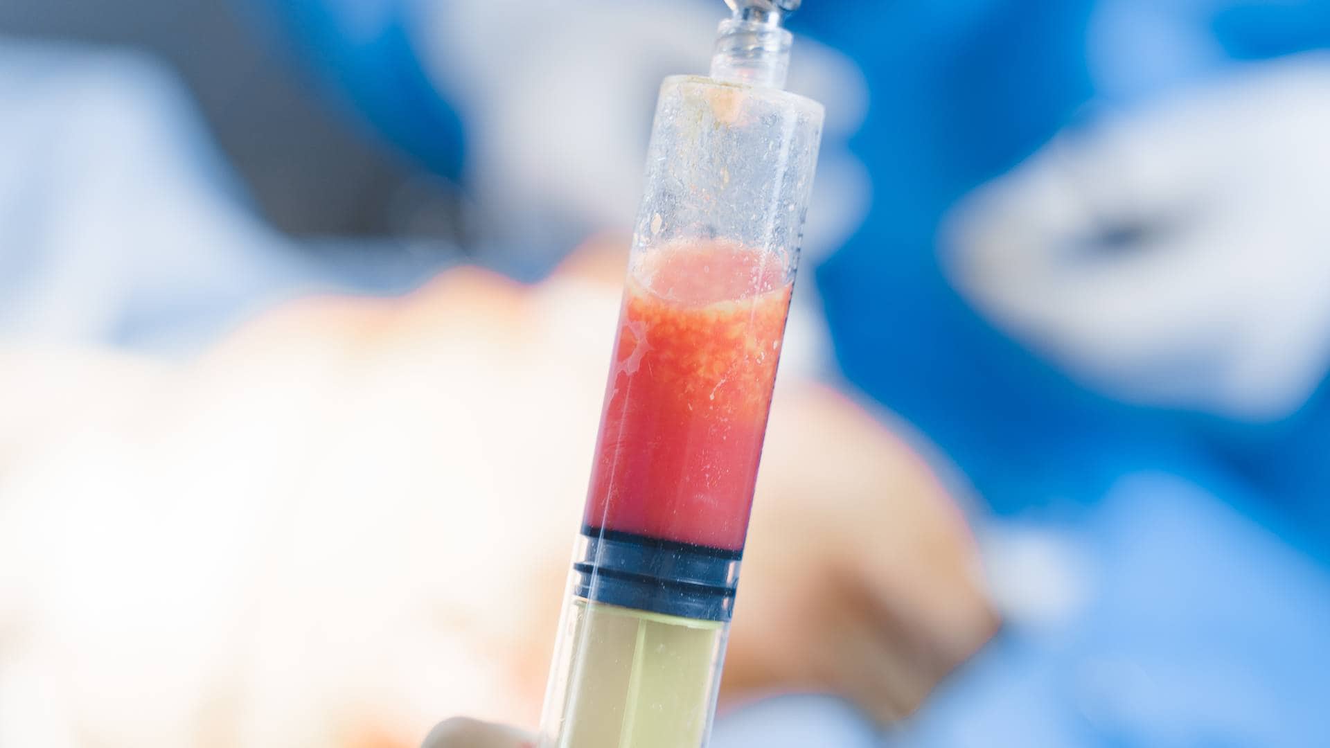 Lipofilling con grasa autóloga en Clínica Fontana Valencia