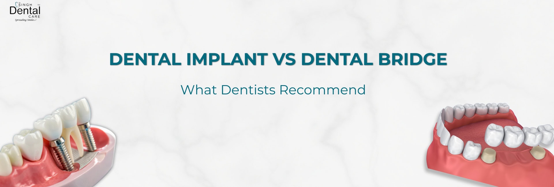 Dental Implant Vs Bridge