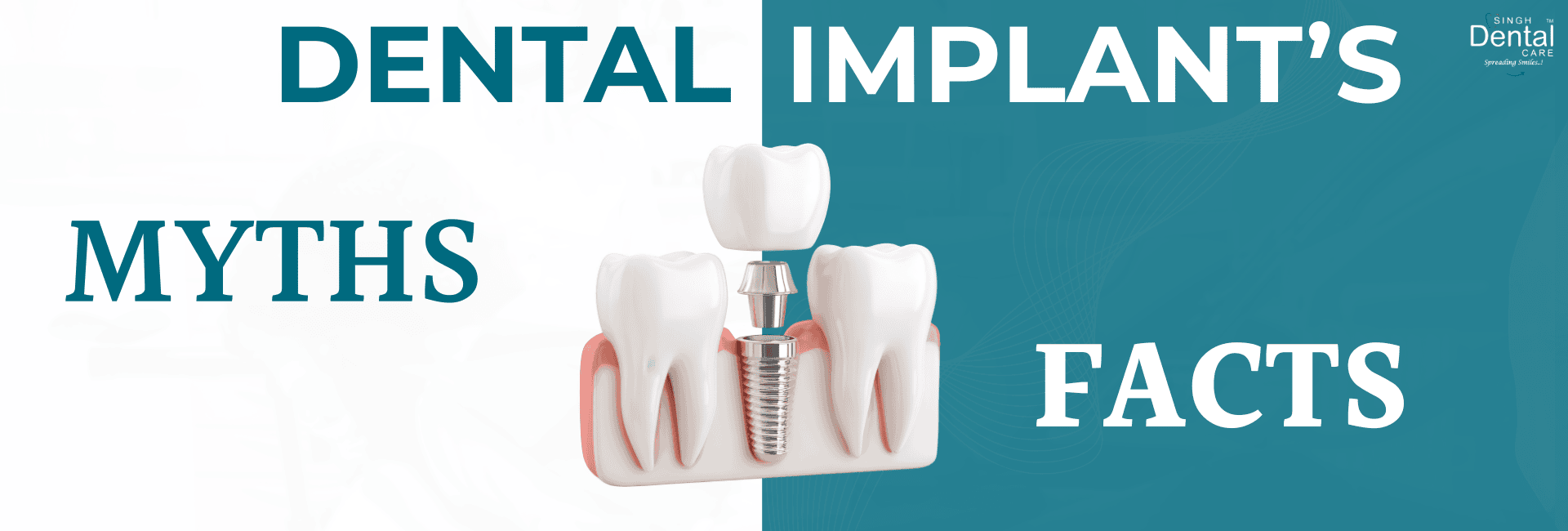 dental implants