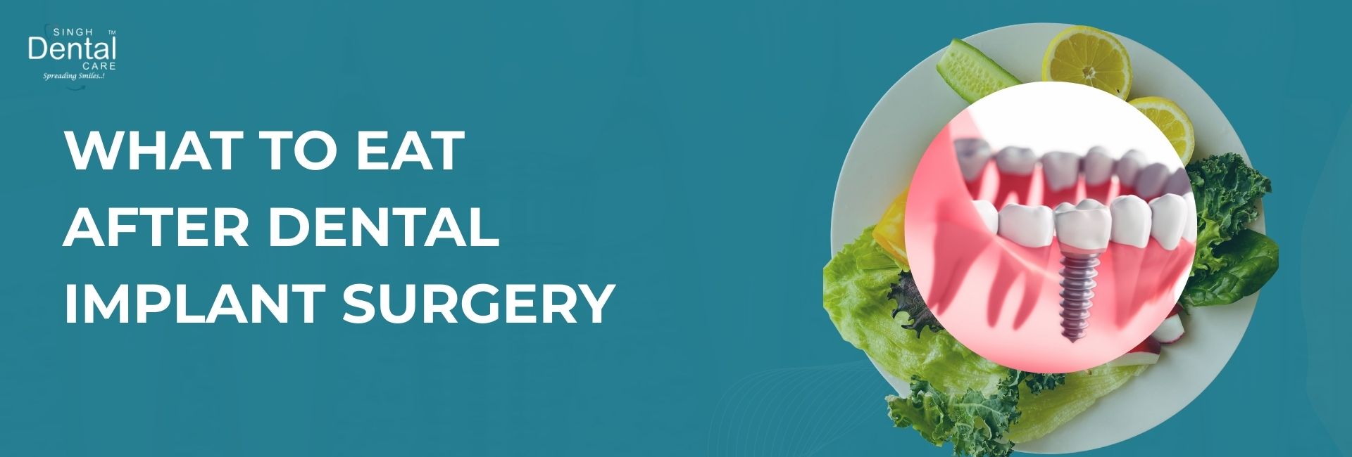 eating after dental implants