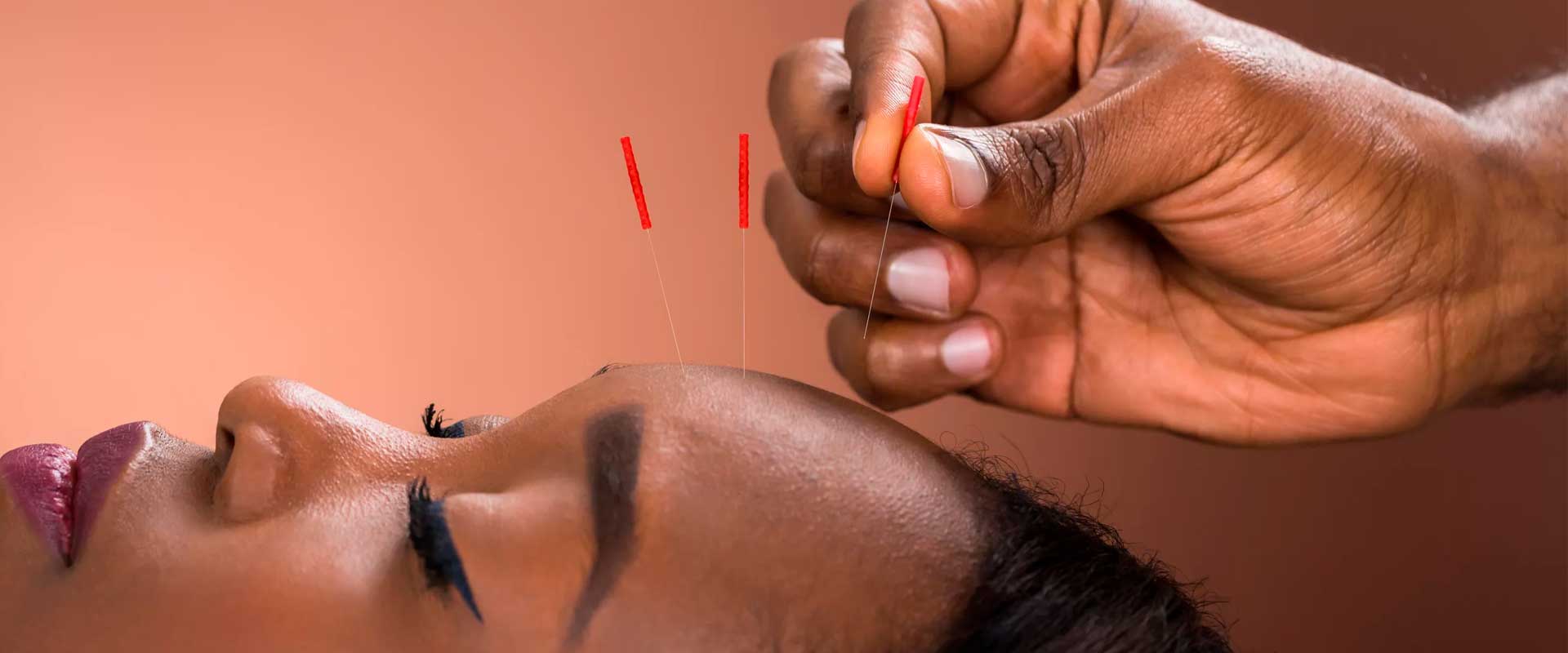 Acupuntura no Tratamento da Tensão Pré-Menstrual (TPM): Uma Abordagem Baseada em Evidências 1 acupuntura medica sao paulo11