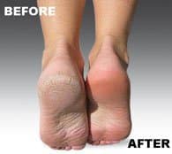 Pedi Electronic Foot File Callus Remover - Image 3