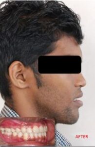 jaw_discrepancy_after