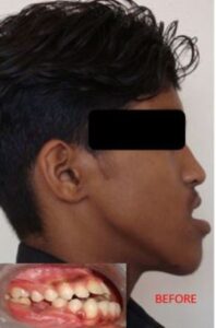 jaw-discrepancy-before