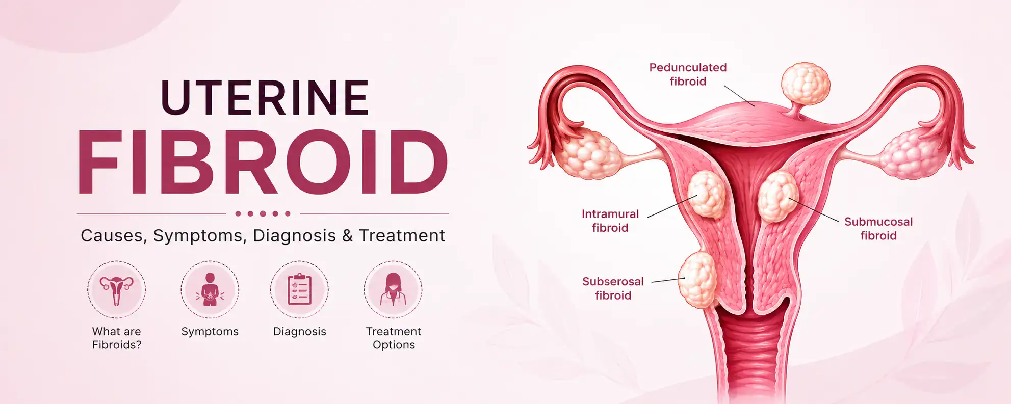 Uterine-fibroids