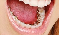 Aparat dentar lingual