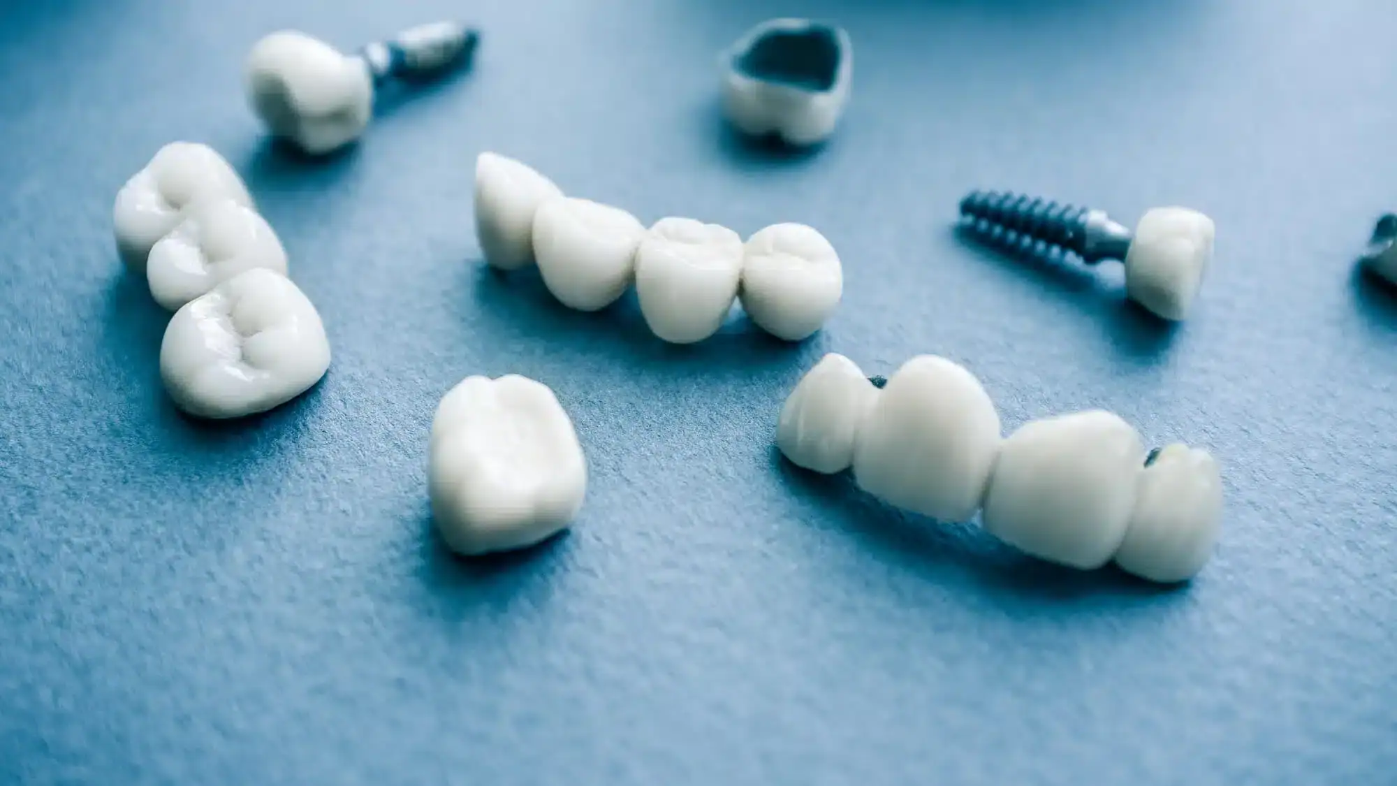 Dental-implants-in-Riverview-MI