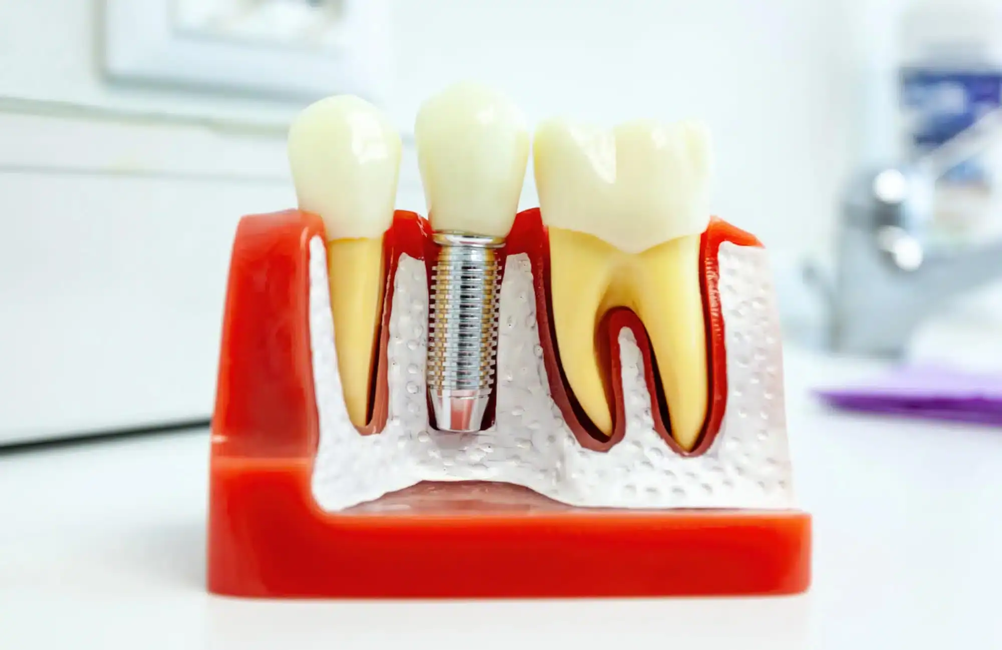 lose-up-of-a-model-for-dental-implants-in-Riverview-MI
