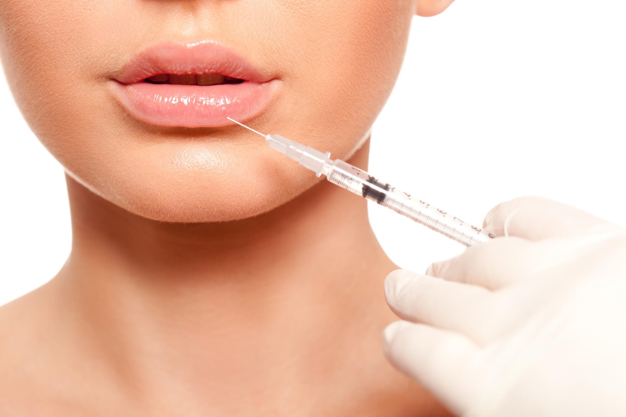 Aumento de labios con ácido hialurónico en Ecuador