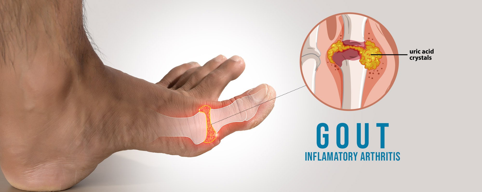 Homeopathy treatment for gout and high uric acid at Dr. Care Homeopathy