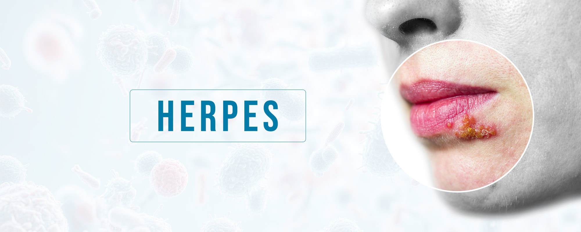 Homeopathy Treatment for Herpes Simplex and Herpes Zoster at Dr Care Homeopathy Clinic